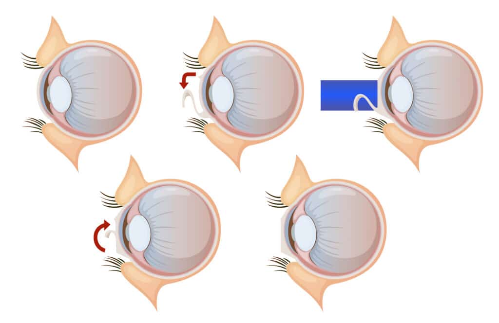 פתרונות ליובש בעיניים לאחר ניתוח לייזר באופטיקה יפעת אופטומטריסטית מוסמכת